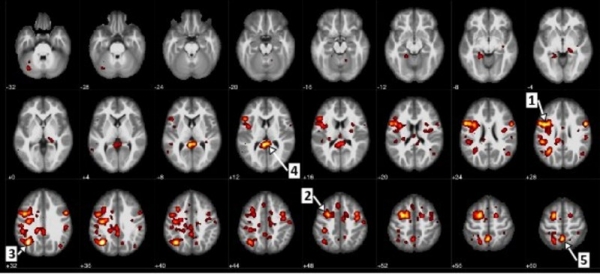 건강인과 조현병 환자 간 유의한 차이를 관찰할 수 있는 뇌 부분(출처: IBM 캐나다)