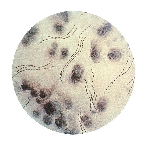 현미경으로 본 헤모필루스 두크레이균[출처=wikikpedia]