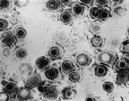 단순 포진 바이러스 종의 비리 온의 TEM 현미경 사진[출처=Wikipedia]