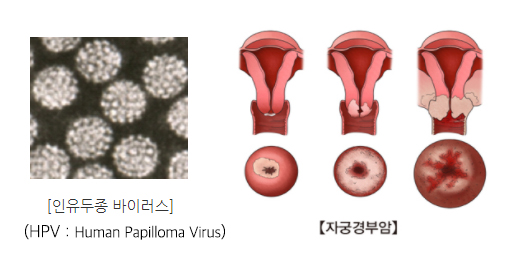 HPV(인유두종 바이러스)와 자궁경부암 설명그림 /서울아산병원