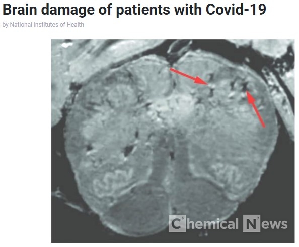 심층 연구에서 NIH 연구원은 COVID-19 환자의 뇌에서 혈관 손상을 지속적으로 발견했지만 SARS-CoV-2 감염의 징후는 없었다. 다음은 환자의 뇌간을 고해상도로 스캔 한 것. 화살표는 연구에서 관찰된 혈관 손상을 나타내는 밝은 점과 어두운 점을 가리킨다 /사진=NIH, 메디컬프레스지 갈무리