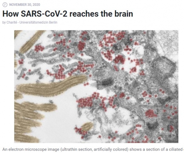 전자 현미경 이미지 (ultrathin 섹션, 인공 채색)는 후각 점막의 섬모 세포 섹션을 보여줍니다. 많은 수의 손상되지 않은 SARS-CoV-2 입자 (빨간색)가 세포 내부와 세포 과정 모두에서 발견된다.