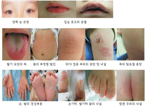 가와사키병으로 비정상적인 면역 반응 증상 /서울아산병원 갈무리
