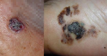 기저 세포암(왼쪽)과 악성 흑색종(오른쪽) /사진=고려대학교안산병원 피부과 질병정보 갈무리