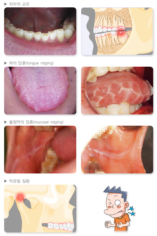 이갈이로 인한 징후 (치아의 교모, 혀와 볼점막의 압흔, 턱관절 질환 등) /대한치의학회, 대한안면통증구강내과학회 갈무리