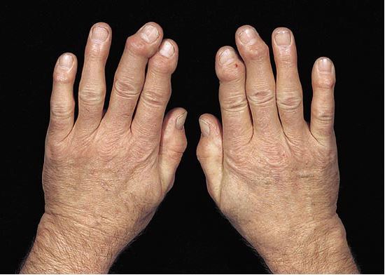 양손의 두 번째 및 세 번째 손가락에서 헤베르덴 결절이 잘 보인다 / MSD 매뉴얼 갈무리