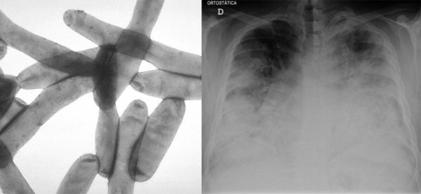 응급실에 입원한 중증 레지오넬라증 환자의 흉부 엑스레이 사진. 양쪽 폐 필드의 아래쪽 3분의 2를 침범하는 광범위한 양측 침윤이 관찰될 수 있다. /PubMed