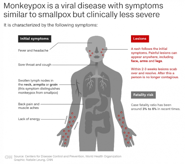 '원숭이두창은 두창(천연두)과 비슷한 증상을 가진 바이러스성 질병이지만 임상적으로 덜 심각하다' /CNN 갈무리