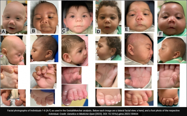 GestaltMatcher 분석에 사용된 개인 1-6(AF)의 얼굴 사진. 각 이미지 아래에는 각 개인의 측면 얼굴 사진, 손, 발 사진이 있다 / 출처 - Genetics in Medicine Open
