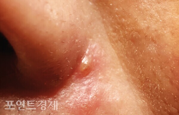 콧망울 옆에 붉게 올라온 수포와 고름이 보이는 피부 병변ⓒ포인트경제 박진우